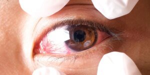 Um médico revela seis sinais sutis de glaucoma que muitas vezes passam despercebidos